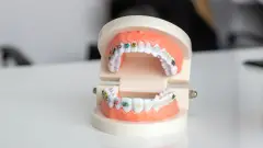 брекети на зуби